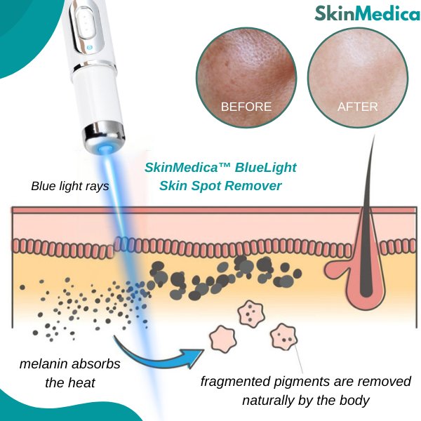 SkinMedica™ BlueLight Skin Spot Remover